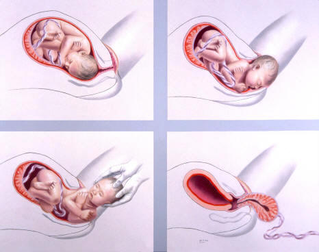 Diferentes fases del parto: encajamiento del feto y dilatación, rotura de aguas, expulsión y alumbramiento